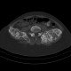 Enchondromatosis, Ollier disease: CT - Computed tomography